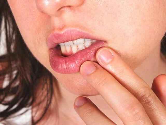 d89d6e24de900c74c9b1cfd2b7d99bba 1 - Как избавиться от простуды на губах? чем лечить быстро и простуду на губах?