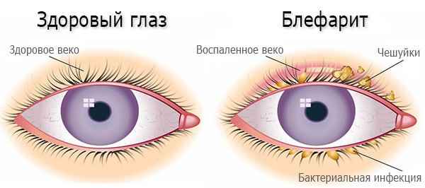d8e7795b93785cd6dabfef409ac7db6b 1 - Как применять капли для глаз альбуцид: состав препарата, инструкция по применению для детей, цена капель
