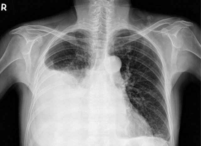 da646129732d31c359b98acb5fab0c26 1 - Жидкость в лёгких: причины и лечение, последствие скопления воды в лёгких, жидкость в лёгких при онкологии