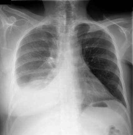 daab095522f0ef48ba0d9d1e8bf9c70b 1 - Плеврит лёгких: особенности, симптомы, а также лечение и профилактика воспаления
