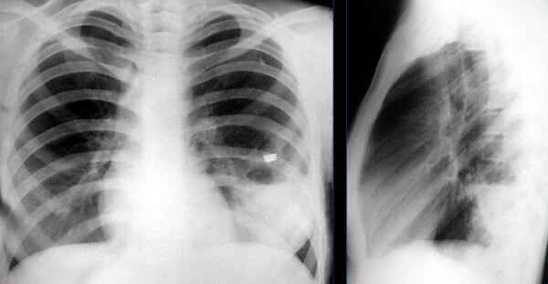 deb09bd21ac74bc384030b6fa4f11d1b 1 - Пневмония на рентгеновских снимках: различия признаков для разных форм болезни на рентгене и фото
