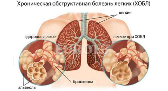 dfdf0c62e8acee187d76213a0405790c 1 - Кашель курильщика: симптомы и лечение медикаментами, чем лечить курение и как от него избавиться