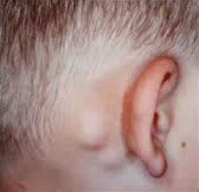 e1677af3021dcda9b5e96019ddf10a0c 1 - Воспалился лимфоузел за ухом: что это за опухоль, почему он может воспаляться, лечение недуга