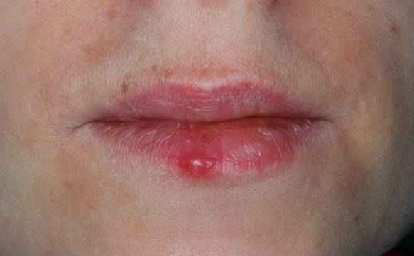 e2d3c0b6a31fa313fba43e5321930402 1 - Как избавиться от простуды на губах? чем лечить быстро и простуду на губах?