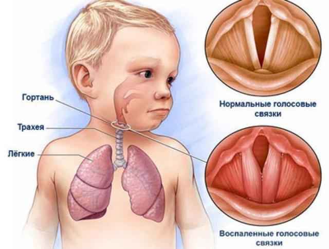 e56e067d9cbac26d3da85f47d28e8f16 1 - Симптомы и лечение ларингита у детей по доктору комаровскому