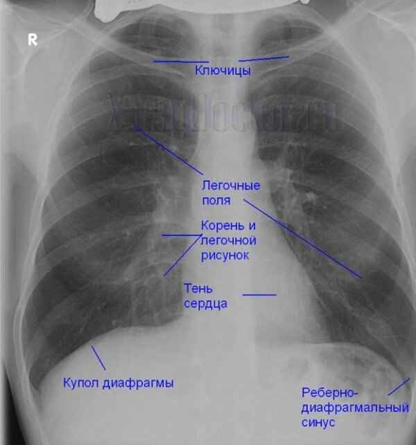 e6e2382a010f3fc3ea3e67b7e0329ec7 1 - Пневмония на рентгеновских снимках: различия признаков для разных форм болезни на рентгене и фото