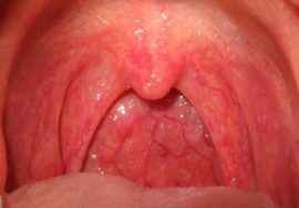 eb1b9a99a7b22cfb34c0087a8a269af9 1 - Миндалины: как выглядят здоровые миндалины в горле, воспаление миндалин, лечение горла