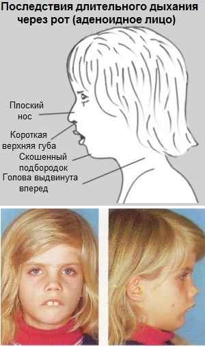 ed94dcfa78542111c3c642c65c852136 1 - Аденоидный тип лица у ребёнка, где находиться и как выглядит, фото