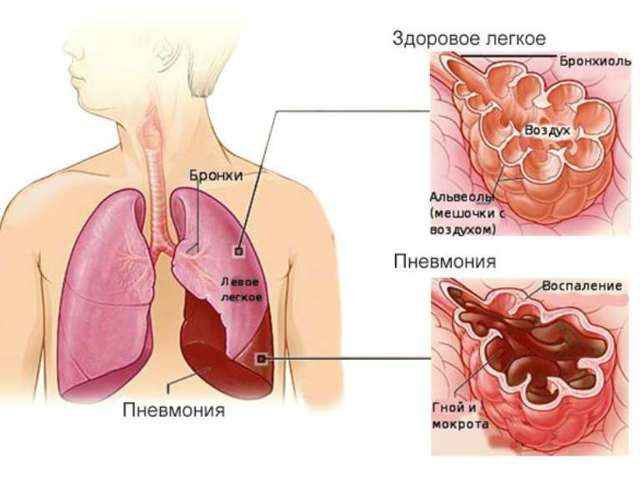 ee8b73ff9a3b9d769c472fbebb468264 1 - Как проявляется воспаление лёгких у взрослого человека без температуры, но с кашлем, симптомы