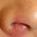 ef77be60f64b149726371aa47abf8a37 1 - Фурункул в носу: причины появления и симптомы фурункулеза, фото, как лечить чирей