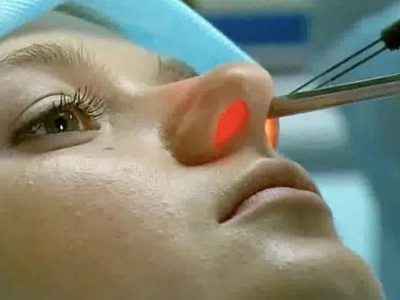 f309189633c77fac3f0d8c3a6b5ba66e 1 - Прижигание слизистой носа лазером: возможные последствия процедуры по операции в носовых сосудах