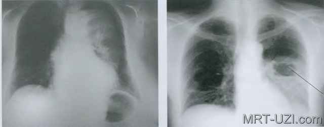 f31181d56eebb8235664f189a31708d7 1 - Пневмония на рентгеновских снимках: различия признаков для разных форм болезни на рентгене и фото