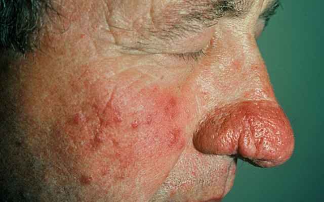 f52c7b9d1173b1db9de8a5f0ee59fa77 1 - Ринофима носа — симптомы, лечение и профилактика заболевания