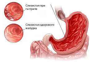 f71a467bc48b40ad5267b5eb49f59b5c 1 - Боль и заложенность за грудиной, ком в горле и сухой кашель