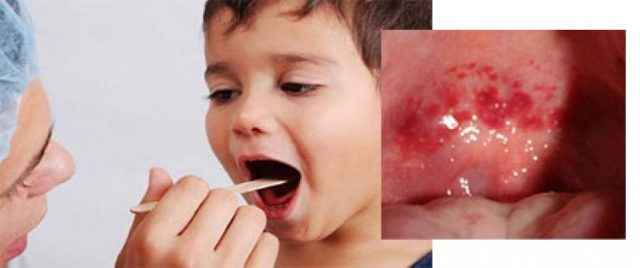 f79be8964eb38800ffdbbdf7a59a3f79 1 - Афтозная герпангина у ребёнка и взрослого: симптомы герпетической ангины и лечение везикулярного фарингита