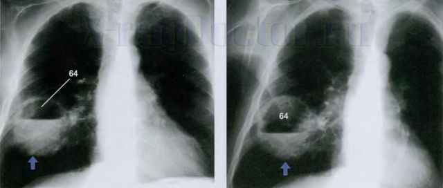 fabff0b37c02a4daa75face294f45633 1 - Пневмония на рентгеновских снимках: различия признаков для разных форм болезни на рентгене и фото