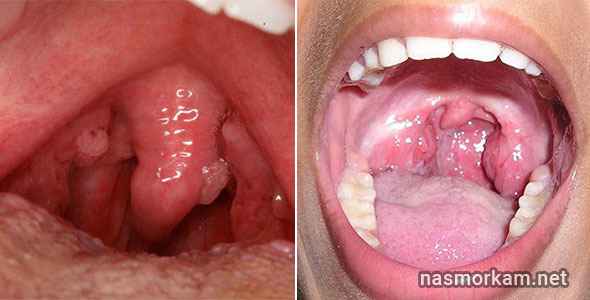 fc0fda2a9313c110aac1eea6788b5218 1 - Отечность небного язычка в горле (увулит): причины, из-за чего он может увеличиваться, симптомы и лечение