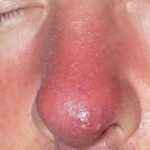 fcfd05158a49a89b23b19f893c1ec5ca 1 - Фурункул в носу: причины появления и симптомы фурункулеза, фото, как лечить чирей