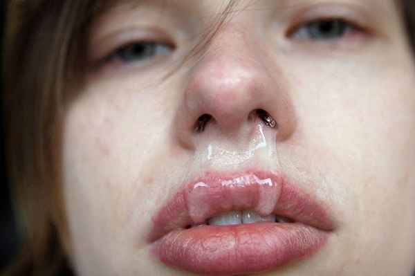fd1227c0716daff4cacf4f7941481471 1 - Что значит гиперемирована слизистая носа: воспалённые слизистые носа и терапия, реструктуризация оболочек носа
