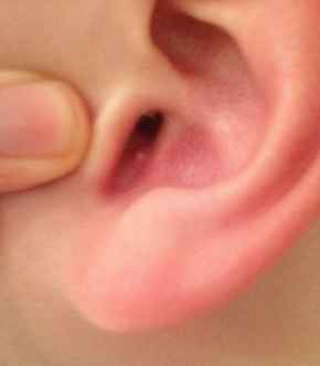 fee12194c14ca045493d6c4903669c48 1 - Шарик на мочке уха: что это такое, причины образования такого уплотнения, почему болит такая шишка?