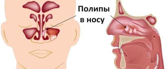 ff3e655631191ddc1ee23beeba0dfab4 1 - Полипоз носа: симптомы заболевания, методы лечения недуга