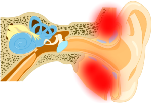 Ostryj mastoidit 300x205 1 - Как можно вылечить ухо: лечение болезней уха в домашних условиях