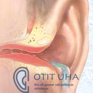 Psihomatika otita 300x300 1 - Репозиция костей носа после перелома: подразделение и симптоматика, диагностика и вправление, репозиция