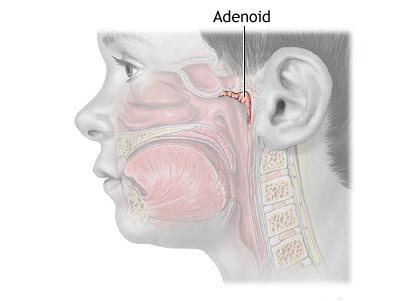 adenoiditxronicheskiysimptomidiagnostika 507B5668 - Аденоидит хронический: выявляем по характерным симптомам!