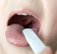 adenoidiudetey23stepenilecheniebezoperat 658588BE - Хлоргексидин: использование препарата для полоскания горла, противопоказания, как полоскать горло детям