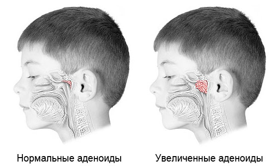 adenoidiudeteysimptomidiagnostikalecheni F4118AF7 - Первая помощь при отите у ребенка и у взрослого: что делать, заложило ухо