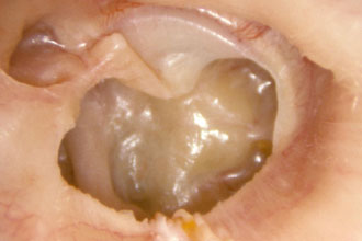 adgezivniyotitsimptomiilechenienarodnimi 86CE5B0A - Применение альбуцида у грудничков: капли в нос, использование у новорождённых