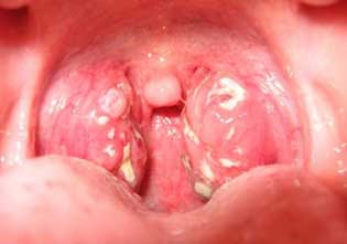 anginailiostriytonzillitsimptomilechenie 8B1D00F1 - Симптомы ангины, признаки и фото