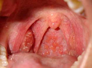 anginailiostriytonzillitsimptomilechenie CA2706F3 - Симптомы ангины, признаки и фото