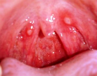 atroficheskiyfaringitsimptomiilechenieuv 6E3C3B2D - Воспаление среднего уха у взрослых – причины, симптомы и лечение воспаления среднего уха