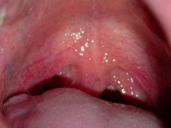 bokovoyfaringitostriyixronicheskiysimpto 51B457C6 - Вазотомия носовых раковин: что это такое, причины проведения операции в нижней части носа и её виды