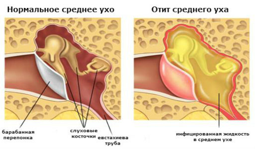 bolitgolovapriotiteosnovnieprichinipoyav CD400E68 - Головная боль при отите: причины и лечение