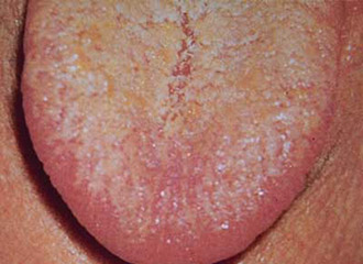 bolitgorloibeliyilizheltiynaletnayazike 1D3ED023 - Герпес в носу: симптомы заболевания, методы лечения, мази от герпеса