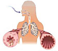bronxialnayaastmaprichinisimptomidiagnos 19037635 - Виды бронхиальной астмы и симптомы
