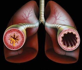 bronxialnayaastmasimptomilechenieprichin E6CF8672 - Виды бронхиальной астмы и симптомы