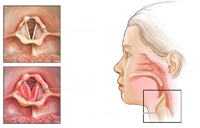 chemlechitlaringituvzroslixsimptomiilech B77A58E5 - Отчего у человека закладывает уши: основные причины и лечение
