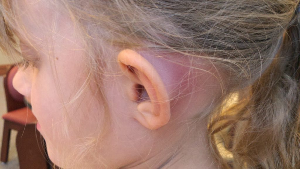 chtodelatesliposlegrippazalozhilouxochem 237196EE - Осложнения на уши у взрослых после отита, гриппа или простуды: что делать, как лечить