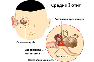 chtotakoeotitivospalenieuxaopisaniebolez 0E6DFBD0 - Может ли у ребенка быть отит без боли в ухе?