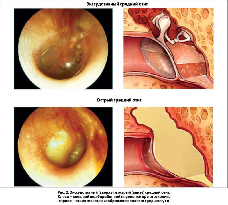 chtotakoeotituxakakviglyaditfotostadiira 04A1EF1C - Отит среднего уха: симптомы и лечение, фото