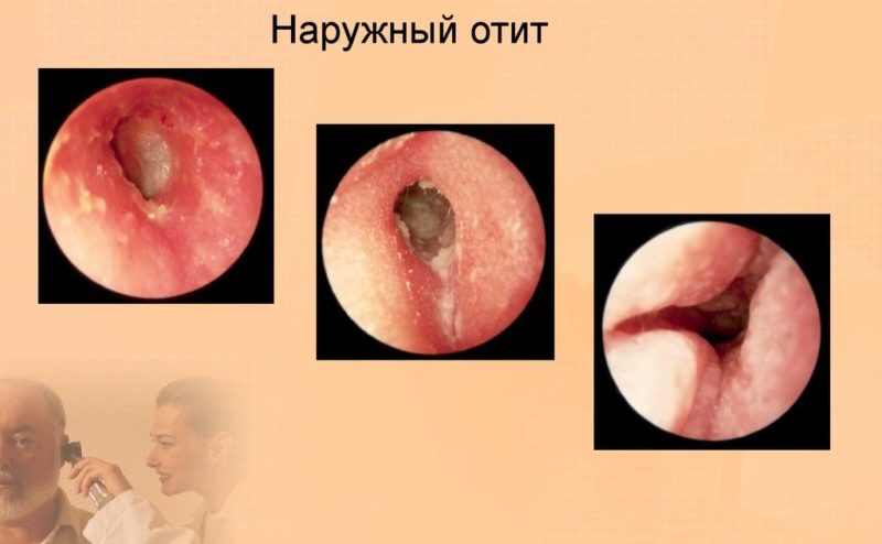 chtotakoeotituxakakviglyaditfotostadiira 374CB971 - Отит среднего уха: симптомы и лечение, фото