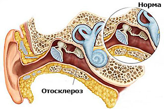 chtotakoeotosklerozsimptomiilechenieambu 93B493C7 - Отосклероз: симптомы, диагностика и лечение