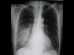 chtotakoepnevmoniyalegkix 3B2BD030 - Спирограмма лёгких: особенности проведения при бронхиальной астме, расшифровка результатов