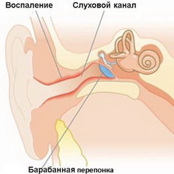 diffuzniyotitnaruzhnogouxafotosimptomiil 21C4FFBD - Диффузный отит наружного уха — симптомы и лечение