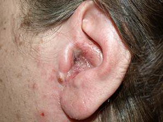 diffuzniyotitnaruzhnogouxafotosimptomiil 4C78547A - Диффузный отит наружного уха — симптомы и лечение