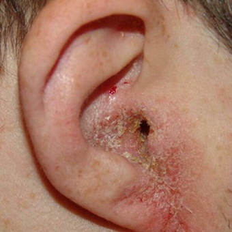 diffuzniyotitnaruzhnogouxafotosimptomiil 61248D22 - Диффузный отит наружного уха — симптомы и лечение