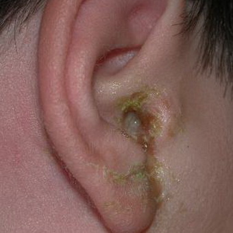 diffuzniyotitnaruzhnogouxafotosimptomiil E787772A - Диффузный отит наружного уха — симптомы и лечение